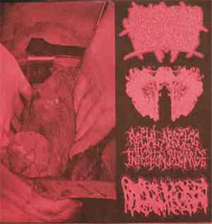 Hydrocephalus : 4-way Gorenoise Split
